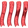 blood clot